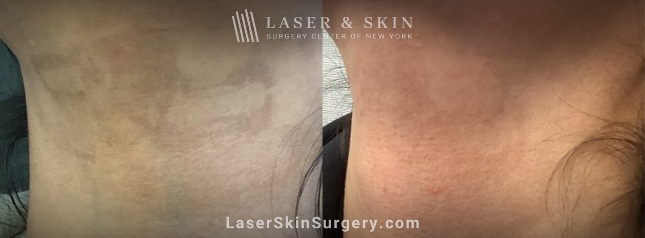 lsscny-nyc-dr-geronemus-post-inflammatory-hyperpigmentation-lasemd laser skin lightening results