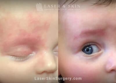 Vbeam laser to treat port wine birthmark on infant’s eye and forehead
