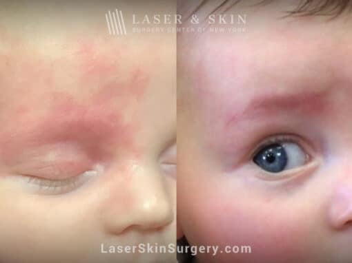 Vbeam laser to treat port wine stain on infant’s eye and forehead