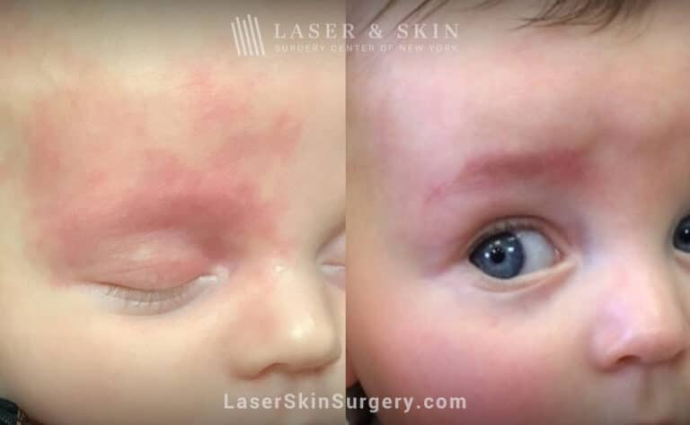 Vbeam laser to treat port wine stain on infant’s eye and forehead