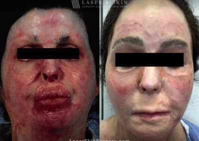 Vbeam, Fraxel Repair, and surgery to treat burn scars on the face