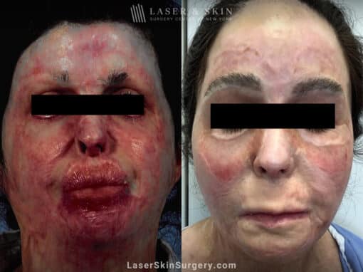 Vbeam, Fraxel Repair, and surgery to treat burn scars on the face