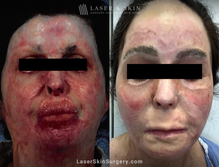 Vbeam, Fraxel Repair, and surgery to treat burn scars on the face