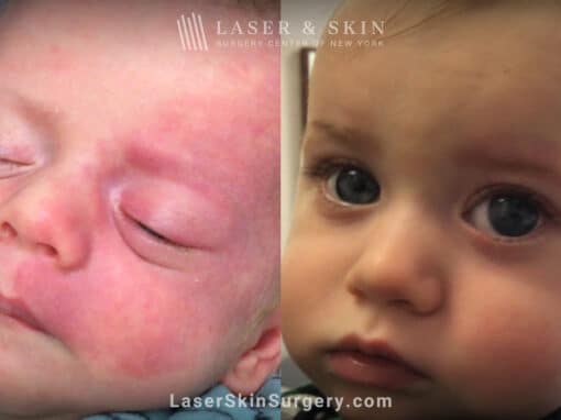 Vbeam laser to treat port wine stain birthmark on the face