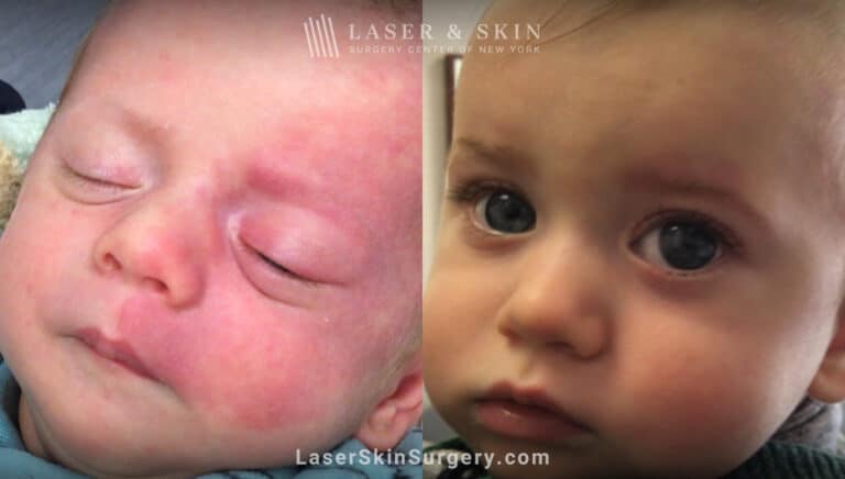 Vbeam laser to treat port wine stain birthmark on the face