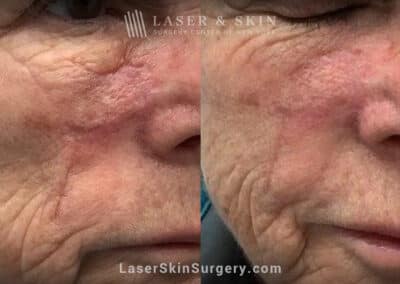 Fraxel laser to treat scar on the cheek