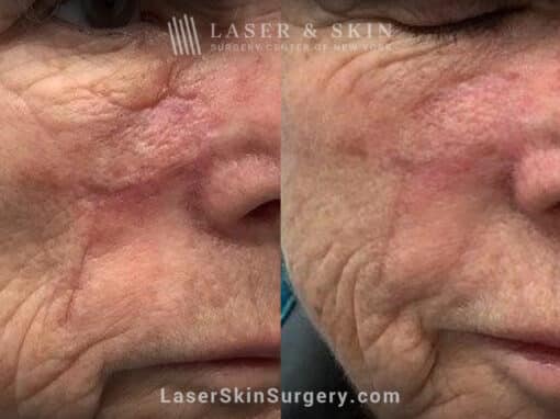 Fraxel laser to treat scar on the cheek