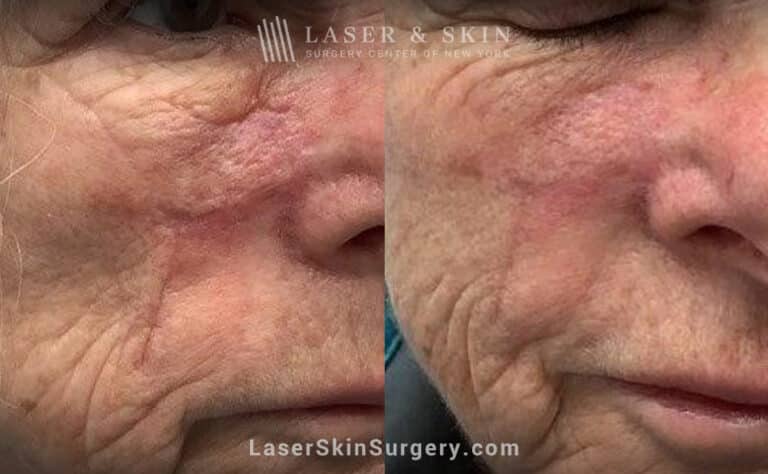 Fraxel laser to treat scar on the cheek