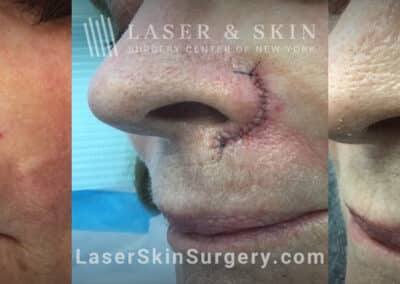 Mohs surgery to remove basal carcinoma under the nose