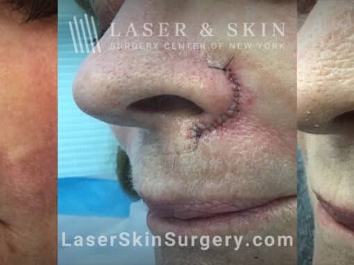 Mohs surgery to remove basal carcinoma under the nose