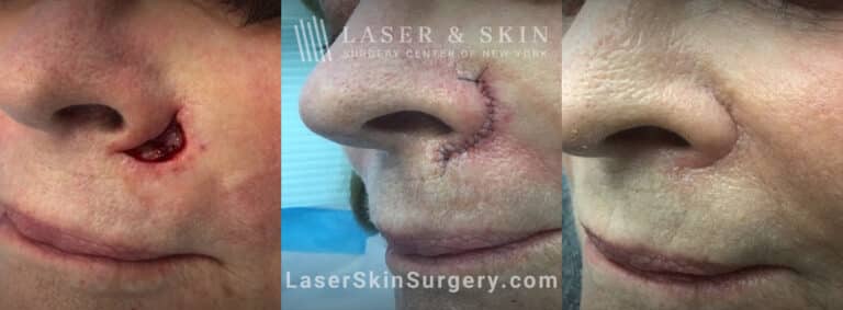 Mohs surgery to remove basal carcinoma under the nose