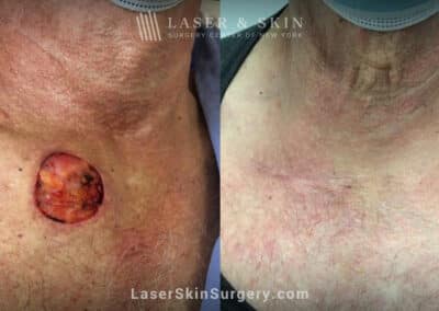 Mohs closure to treat skin cancer on the chest