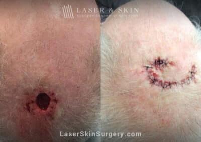 Mohs surgery to treat skin cancer on the scalp