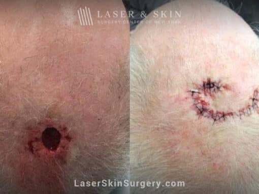 Mohs surgery to treat skin cancer on the scalp