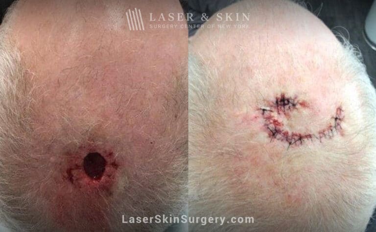 Mohs surgery to treat skin cancer on the scalp