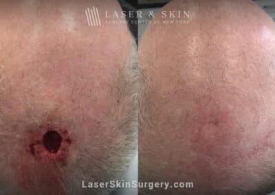 Mohs surgery to treat skin cancer on the scalp