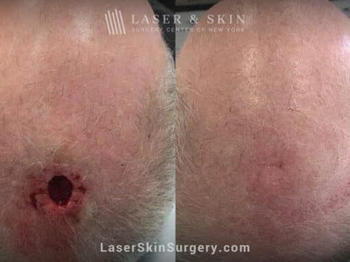 Mohs surgery to treat skin cancer on the scalp