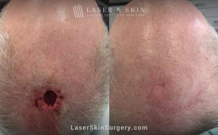 Mohs surgery to treat skin cancer on the scalp