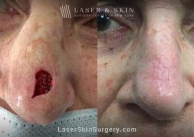 Mohs surgery to treat skin cancer on the nose