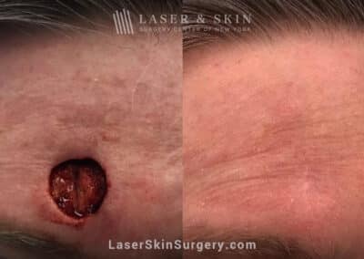 Mohs surgery to treat skin cancer on the forehead
