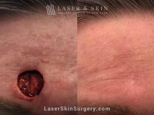 Mohs surgery to treat skin cancer on the forehead