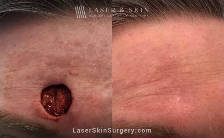 Mohs surgery to treat skin cancer on the forehead