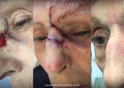 Mohs surgery to treat skin cancer on the side of the nose