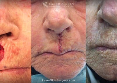 Mohs surgery to treat skin cancer above the lip