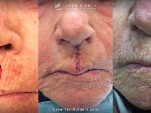 Mohs surgery to treat skin cancer above the lip