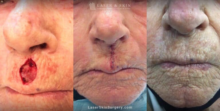 Mohs surgery to treat skin cancer above the lip