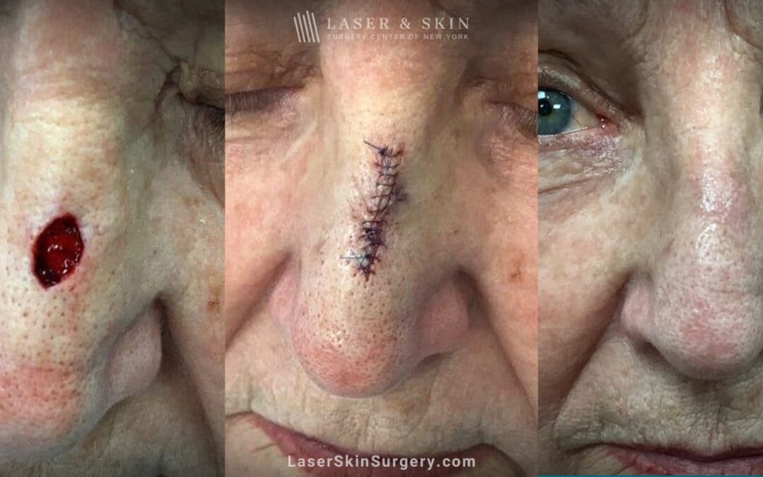 Mohs surgery to treat skin cancer on the nose