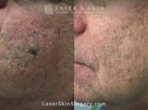 Ruby laser treatment to completely eradicate sun spot on the cheek