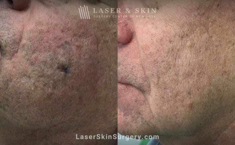 Ruby laser treatment to completely eradicate sun spot on the cheek