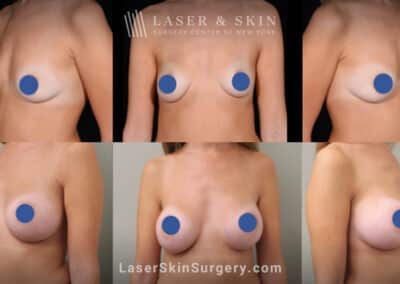 Breast augmentation with silicone implants