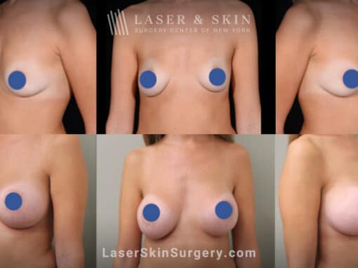 Breast augmentation with silicone implants