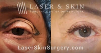Upper and lower blepharoplasty to enhance the eyes