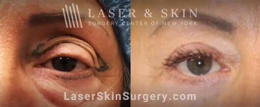 Upper and lower blepharoplasty to enhance the eyes