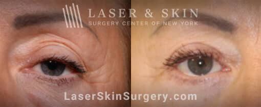 Upper and lower blepharoplasty to refresh the eyes