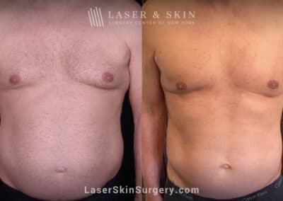 Body contouring procedure to reduce abdominal fat