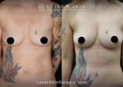 Breast augmentation and body contouring procedure to reduce abdominal fat