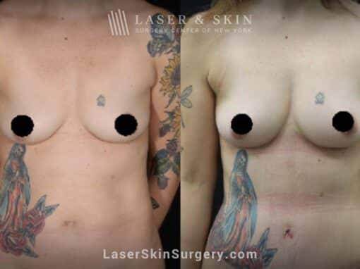 Breast augmentation and body contouring procedure to reduce abdominal fat