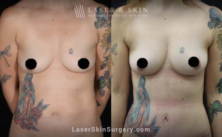 Breast augmentation and body contouring procedure to reduce abdominal fat