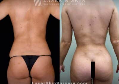 Body contouring procedure to reduce fat and enhance the buttocks