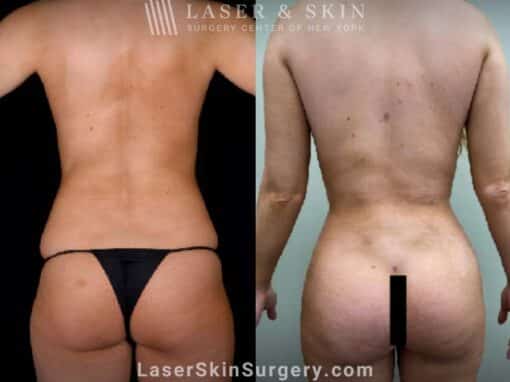 Body contouring procedure to reduce fat and enhance the buttocks