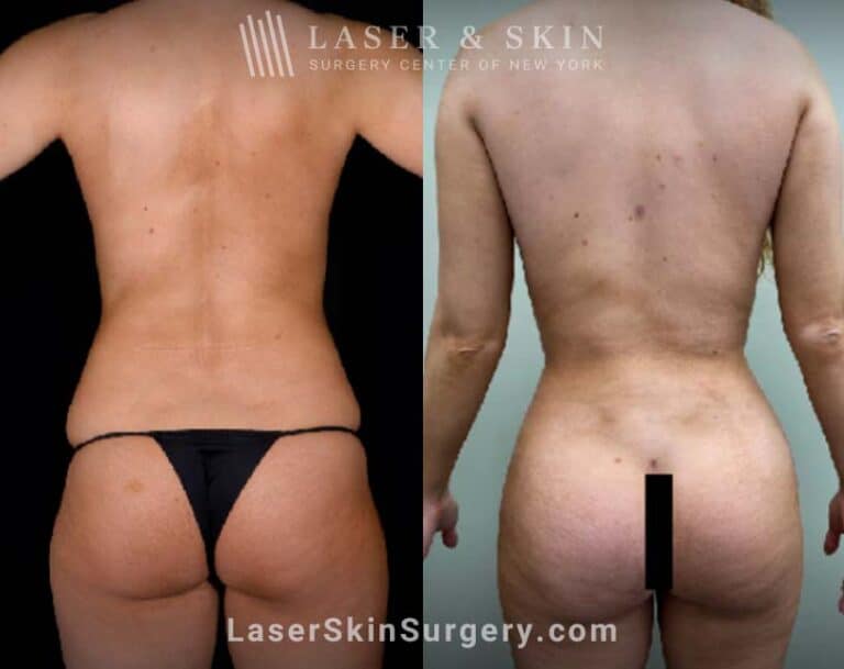 Body contouring procedure to reduce fat and enhance the buttocks