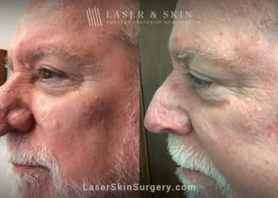 Radiofrequency treatment for rhinophyma