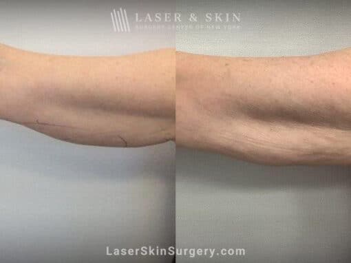 CoolSculpting to Tighten the Arms and Remove Unwanted Fat