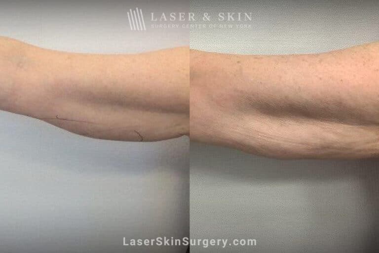 CoolSculpting to Tighten the Arms and Remove Unwanted Fat