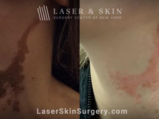 Erbium laser treatment for epidermal nevus on neck