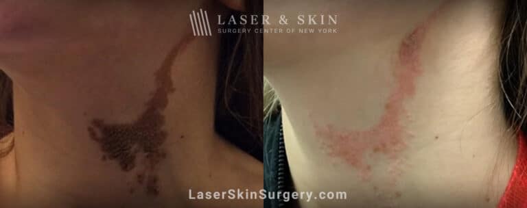 Erbium laser treatment for epidermal nevus on neck